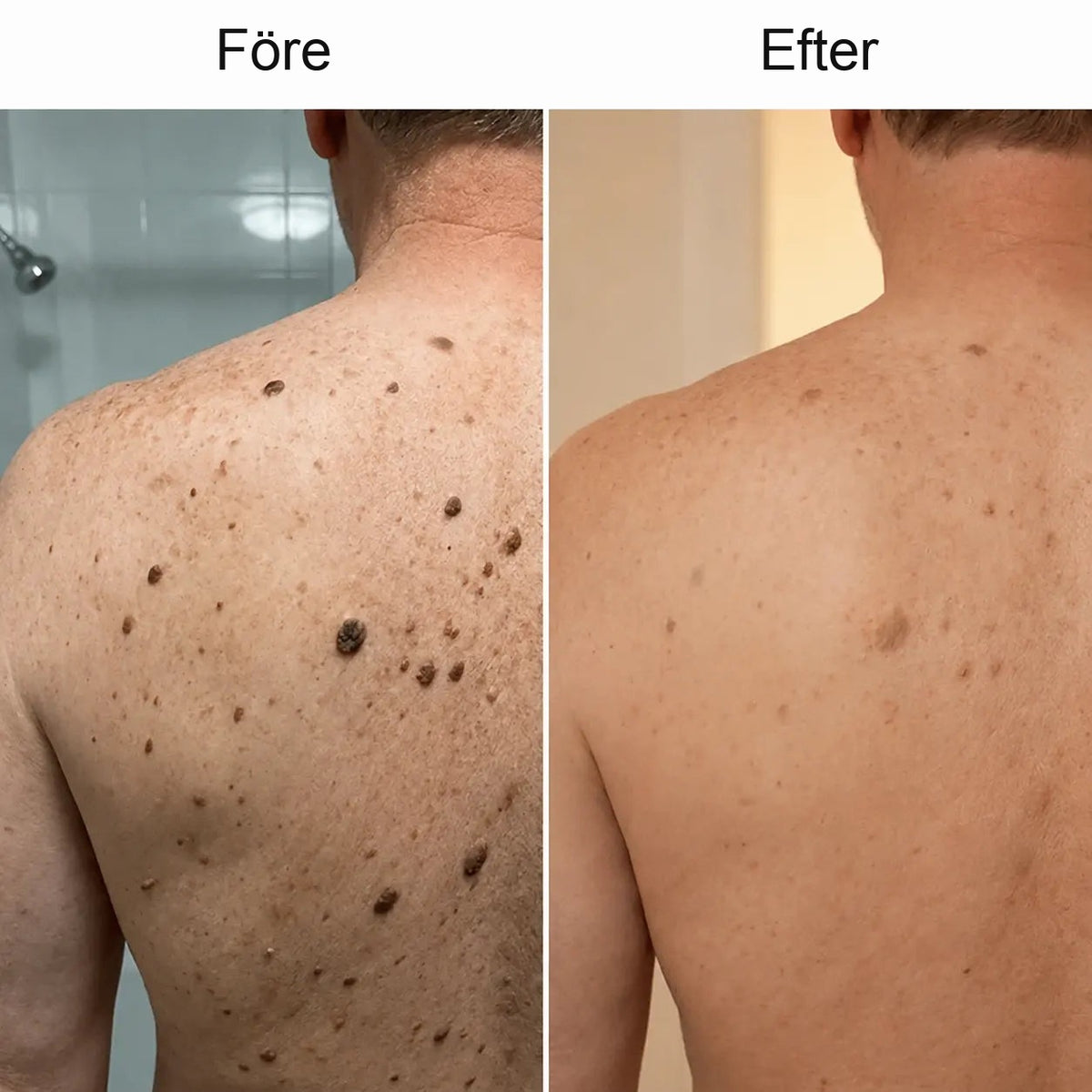 Cazoly Glykolsyra Exfolierande Body Stick